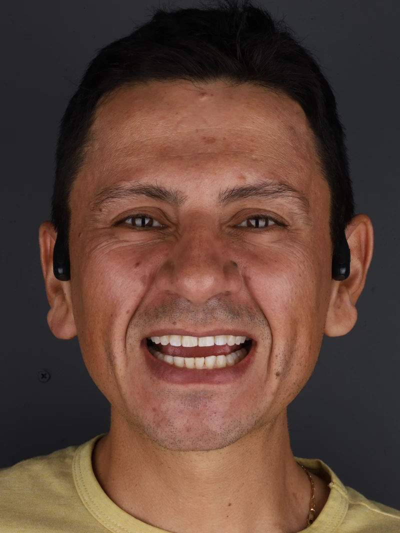 Camilo · Antes